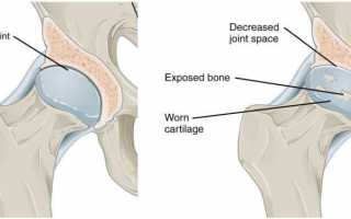 Как лечить сужение суставных щелей