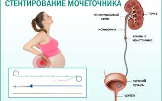 Установка стента беременным женщинам