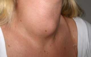 Причины образования гипоэхогенных узлов на щитовидной железе и методы их лечения