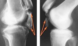 Что такое лигаментоз коленного сустава и как его лечить