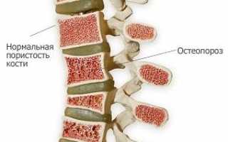 Какие препараты кальция лучше при остеопорозе