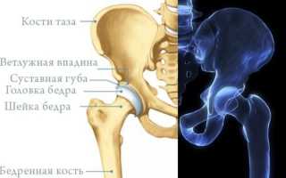 Как лечить диспластический коксартроз тазобедренного сустава