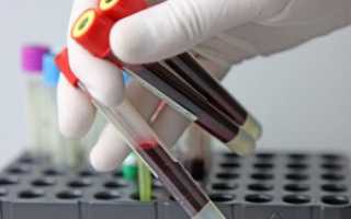 Общий анализ крови при ВИЧ: назначение и изменения показателей