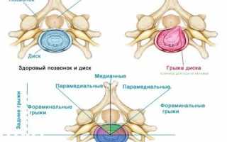 Что такое дорзальная грыжа и как её лечат