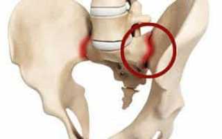 О чем говорит боль в крестцово-подвздошном суставе