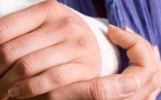 Как лечить выбитый палец на руке