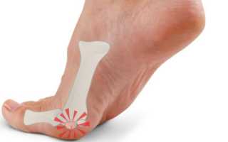 Что делать, если болит сустав большого пальца на ноге