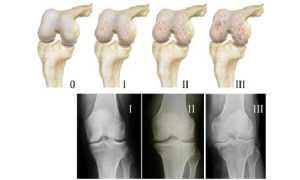 Как лечат артроз коленного сустава
