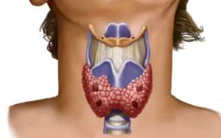 Медуллярный рак щитовидной железы: все о патологии