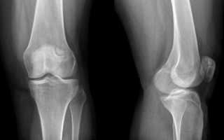 Виды заболеваний коленных суставов