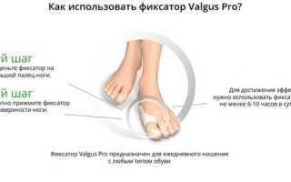 Насколько эффективен фиксатор для большого пальца Valgus Pro