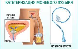 Особенности процедуры катетеризации мочеточника
