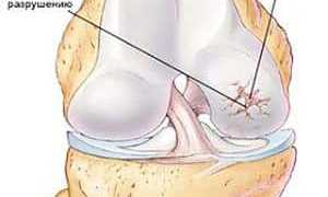 Как лечить артрит лучезапястного сустава