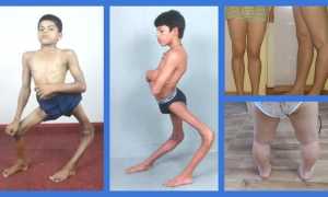 Как лечить рекурвацию коленного сустава