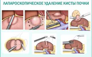 Обзор методов удаления почечных кист