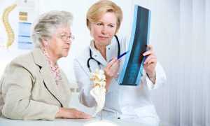 Как лечить остеопороз позвоночника