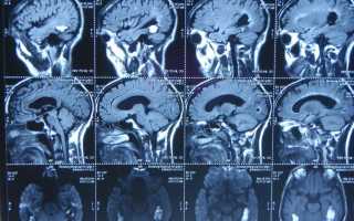 Как проверить сосуды головного мозга и шеи, для чего это нужно