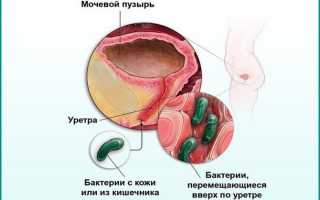 Воспаленный мочевой пузырь: особенности патологии