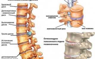 Что такое спондилодисцит позвоночника и как его лечат