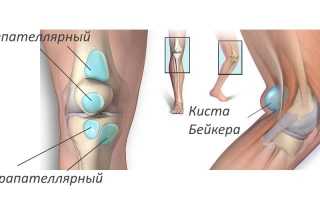 Как лечить препателлярный бурсит коленного сустава