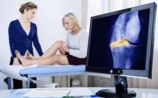 Как лечить артрит ног