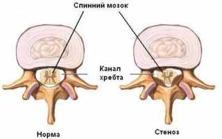 Как лечить стеноз позвоночного канала шейного отдела