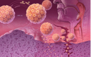 Иммунотерапия рака головы и шеи
