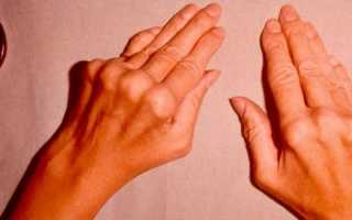 Как лечить артроз пальцев рук