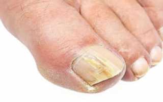 Как диагностируется и лечится грибковое поражение ногтей (дерматофитный онихомикоз)