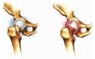 Как лечить артрит тазобедренного сустава