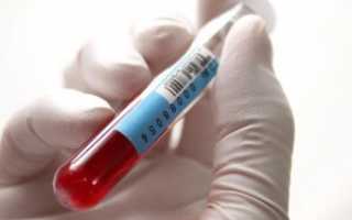 Исследование крови на ПСА свободный: норма и возможные отклонения