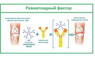 Что такое ревматоидный фактор