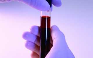 Анализ крови на ревматоидный фактор: значение, назначение и расшифровка анализа