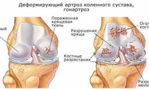 Как лечить деформирующий артроз коленных суставов