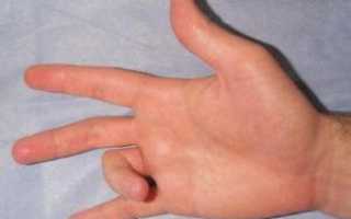 Как лечить щелкающий палец на руке