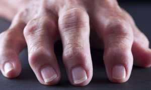 Как лечить бурсит кисти руки и пальцев