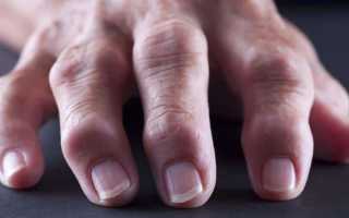Как лечить бурсит кисти руки и пальцев
