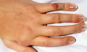 Как лечить наросты на суставах пальцев рук