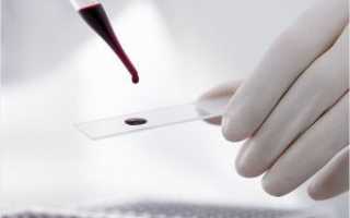 Как определить вирусную и бактериальную инфекцию по анализу крови?