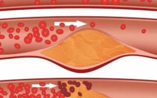 Повышение холестерина ЛПНП: проведение анализа и причины отклонения