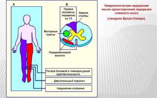 Как лечить синдром Броун-Секара