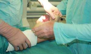 Как лечить деформацию пальцев ног и рук