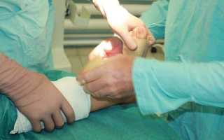 Как лечить деформацию пальцев ног и рук