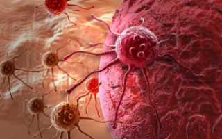 Колоректальный рак – что это та патология и чем она опасна?