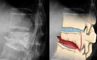 Что такое компрессионный перелом позвоночника и как он лечится