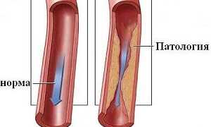 Что такое гипоплазия позвоночной артерии