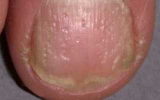 Причины и лечение онихолизиса (отслоения ногтя от мягких тканей пальца)