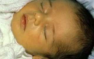 Физиологическая желтуха у новорожденных детей