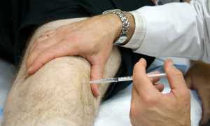 Какие уколы делают в коленный сустав при артрозе