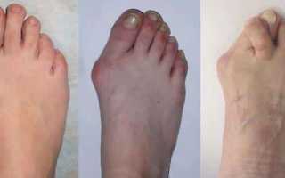 Как лечить артроз пальцев ног